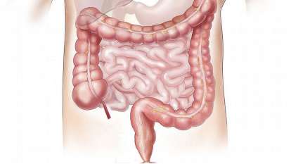 Intestino irritável