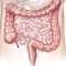 Síndrome do intestino irritável: causas, sintomas, tratamento