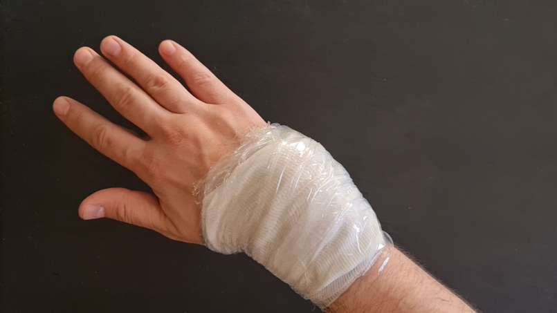 Cataplasma com folhas de repolho e loys, foto 7